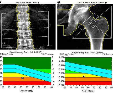 can a dexa scan show bone cancer? what other diagnostic methods are available?