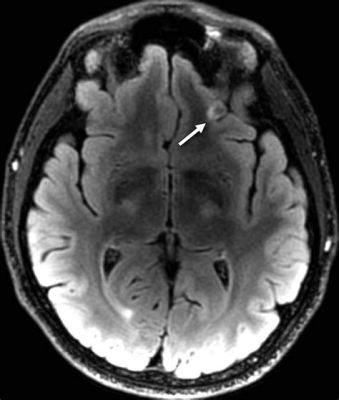 does scar tissue show up on mri and can it indicate past trauma?